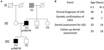 Case Report: Rare Presentation of Dentin Abnormalities in Loeys-Dietz Syndrome Type I